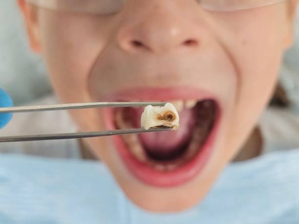 Best Cracked Tooth Emergency Dentist  in Keuka Park, NY